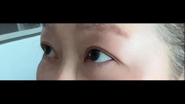 Sub-brow Lift, Ptosis Correction — RE&RE PLASTIC SURGERY 5