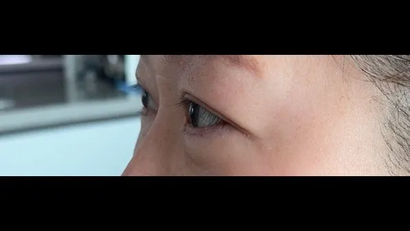 Sub-brow Lift, Ptosis Correction — RE&RE PLASTIC SURGERY 6