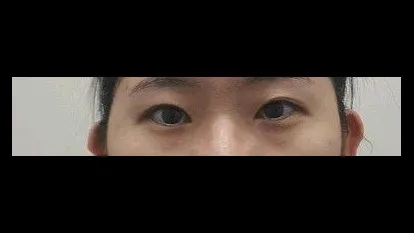 Natural Adhesion Double Eyelid Surgery — RE&RE PLASTIC SURGERY 1