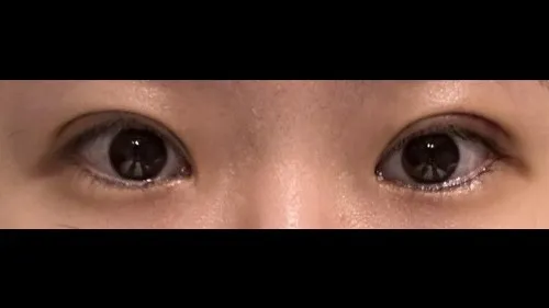 Natural Adhesion Double Eyelid Surgery — RE&RE PLASTIC SURGERY 2