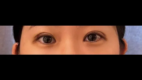 Natural Adhesion Double Eyelid Surgery — RE&RE PLASTIC SURGERY 3