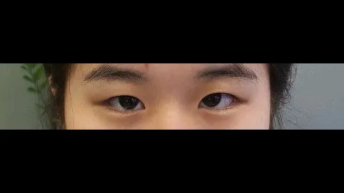 Partial Incision Double Eyelid Surgery, Ptosis Correction — RE&RE PLASTIC SURGERY 1