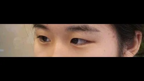 Partial Incision Double Eyelid Surgery, Ptosis Correction — RE&RE PLASTIC SURGERY 2