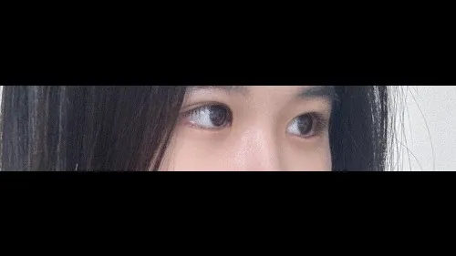 Partial Incision Double Eyelid Surgery, Ptosis Correction — RE&RE PLASTIC SURGERY 3
