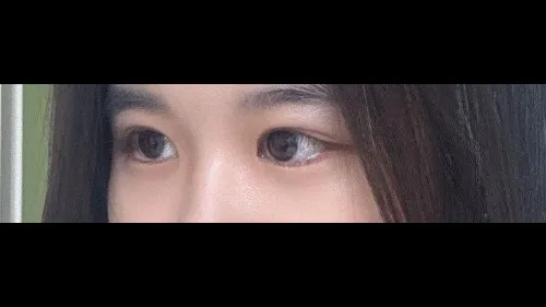 Partial Incision Double Eyelid Surgery, Ptosis Correction — RE&RE PLASTIC SURGERY 4