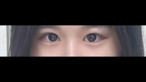Partial Incision Double Eyelid Surgery, Ptosis Correction — RE&RE PLASTIC SURGERY 5