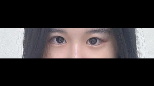 Partial Incision Double Eyelid Surgery, Ptosis Correction — RE&RE PLASTIC SURGERY 6