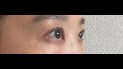 Incisional Double Eyelid Surgery, Ptosis Correction — RE&RE PLASTIC SURGERY 2