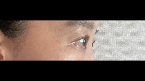 Incisional Double Eyelid Surgery, Ptosis Correction — RE&RE PLASTIC SURGERY 3