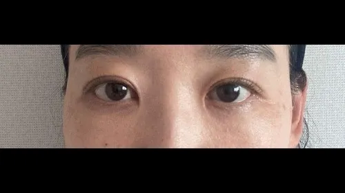Incisional Double Eyelid Surgery, Ptosis Correction — RE&RE PLASTIC SURGERY 4