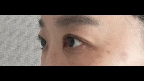 Incisional Double Eyelid Surgery, Ptosis Correction — RE&RE PLASTIC SURGERY 5