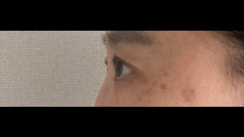Incisional Double Eyelid Surgery, Ptosis Correction — RE&RE PLASTIC SURGERY 6