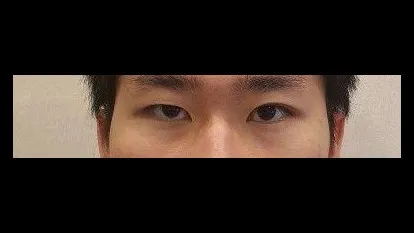 Natural Adhesion Double Eyelid Surgery, Ptosis Correction, Nasal Tip, Nasal Bridge, Hump Nose 1