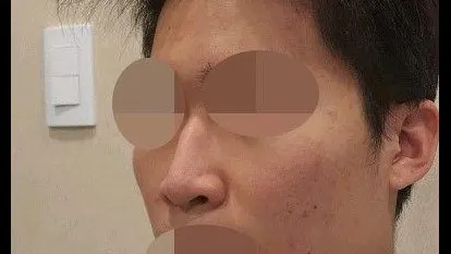 Natural Adhesion Double Eyelid Surgery, Ptosis Correction, Nasal Tip, Nasal Bridge, Hump Nose 2