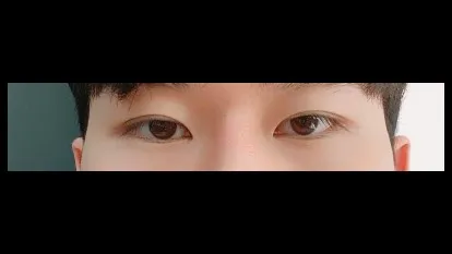 Natural Adhesion Double Eyelid Surgery, Ptosis Correction, Nasal Tip, Nasal Bridge, Hump Nose — RE&RE PLASTIC SURGERY 3