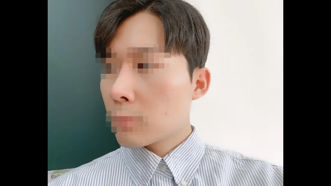 Natural Adhesion Double Eyelid Surgery, Ptosis Correction, Nasal Tip, Nasal Bridge, Hump Nose — RE&RE PLASTIC SURGERY 4