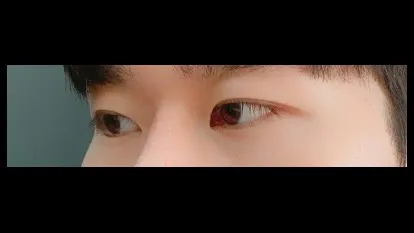 Natural Adhesion Double Eyelid Surgery, Ptosis Correction, Nasal Tip, Nasal Bridge, Hump Nose — RE&RE PLASTIC SURGERY 5