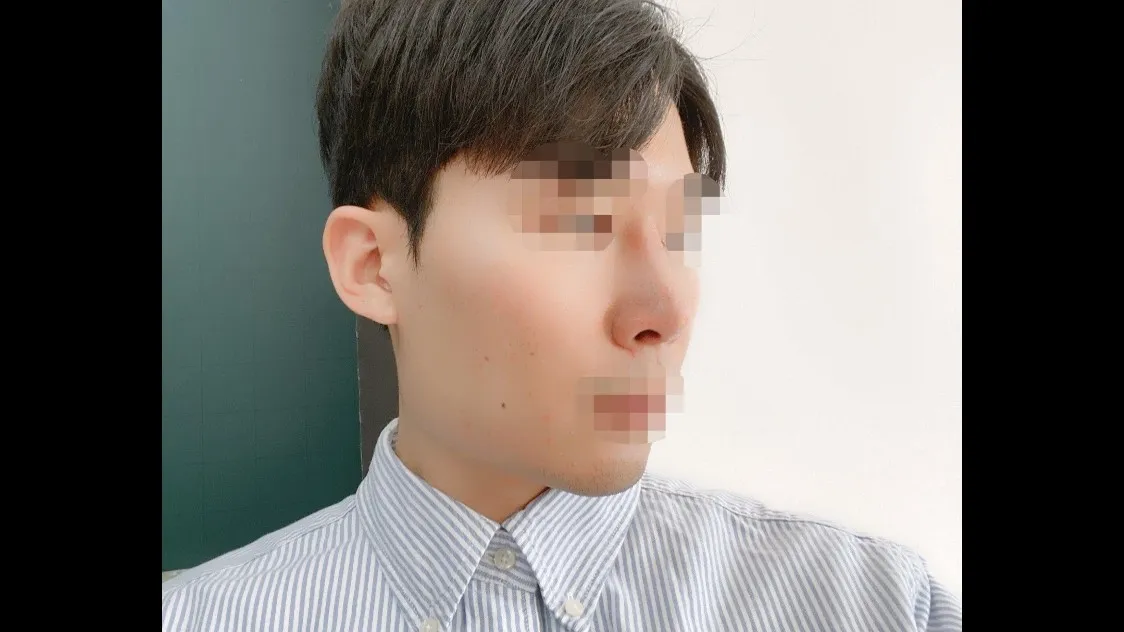 Natural Adhesion Double Eyelid Surgery, Ptosis Correction, Nasal Tip, Nasal Bridge, Hump Nose — RE&RE PLASTIC SURGERY 6