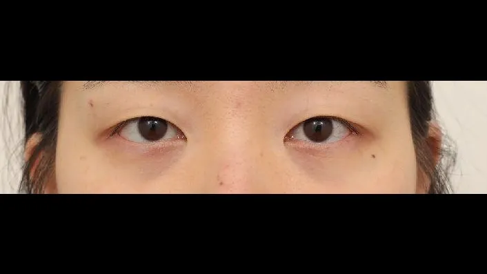 Natural Adhesion Double Eyelid Surgery — RE&RE PLASTIC SURGERY 1