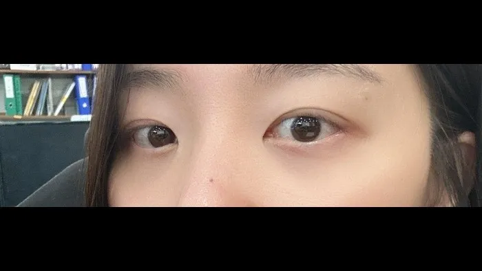 Natural Adhesion Double Eyelid Surgery — RE&RE PLASTIC SURGERY 2