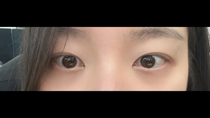 Natural Adhesion Double Eyelid Surgery — RE&RE PLASTIC SURGERY 3
