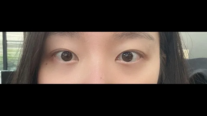 Natural Adhesion Double Eyelid Surgery — RE&RE PLASTIC SURGERY 4