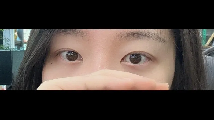 Natural Adhesion Double Eyelid Surgery — RE&RE PLASTIC SURGERY 5