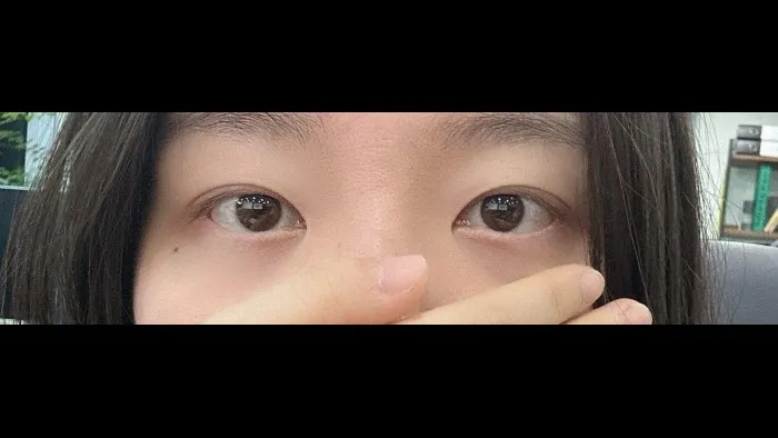Natural Adhesion Double Eyelid Surgery — RE&RE PLASTIC SURGERY 6