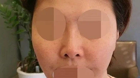 Nasal Tip, Nasal Bridge, Alar Base Reduction 1