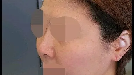 Nasal Tip, Nasal Bridge, Alar Base Reduction 2