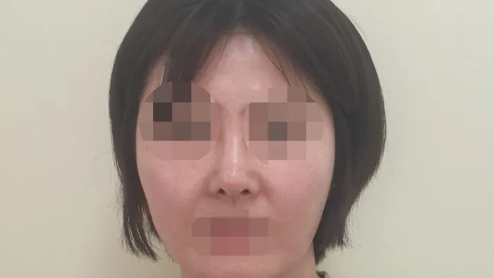 Nasal Tip, Nasal Bridge, Alar Base Reduction — RE&RE PLASTIC SURGERY 3