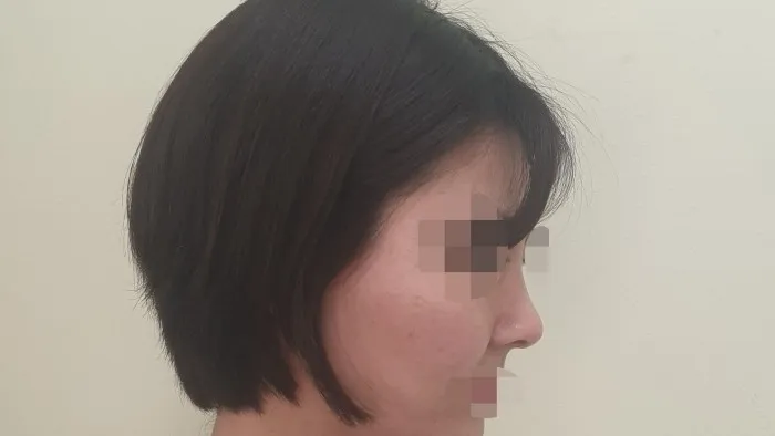 Nasal Tip, Nasal Bridge, Alar Base Reduction — RE&RE PLASTIC SURGERY 4