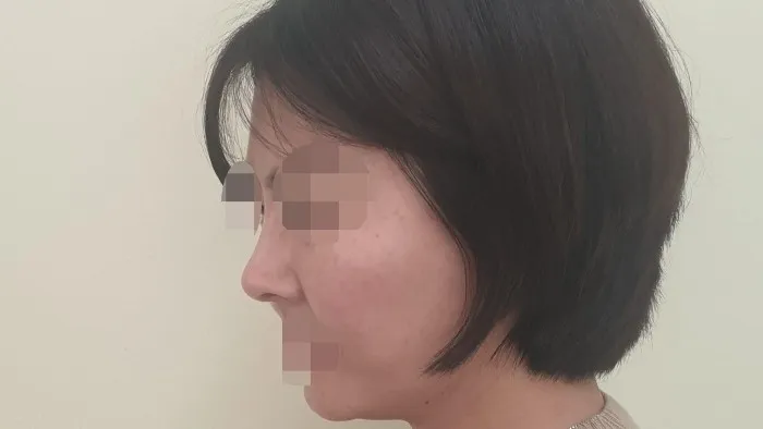 Nasal Tip, Nasal Bridge, Alar Base Reduction — RE&RE PLASTIC SURGERY 5