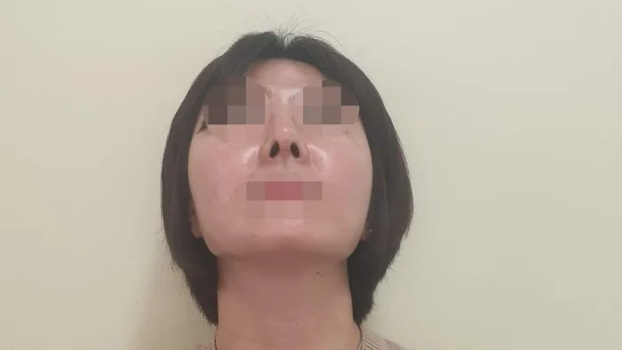 Nasal Tip, Nasal Bridge, Alar Base Reduction — RE&RE PLASTIC SURGERY 6