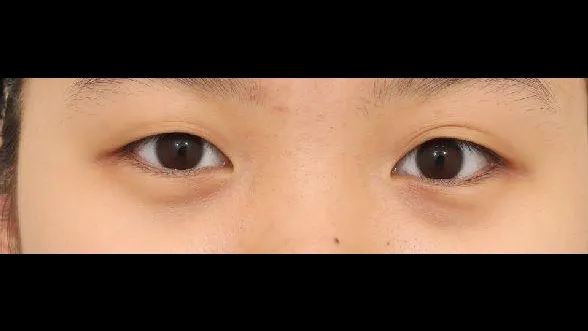Partial Incision Double Eyelid Surgery, Ptosis Correction — RE&RE PLASTIC SURGERY 1