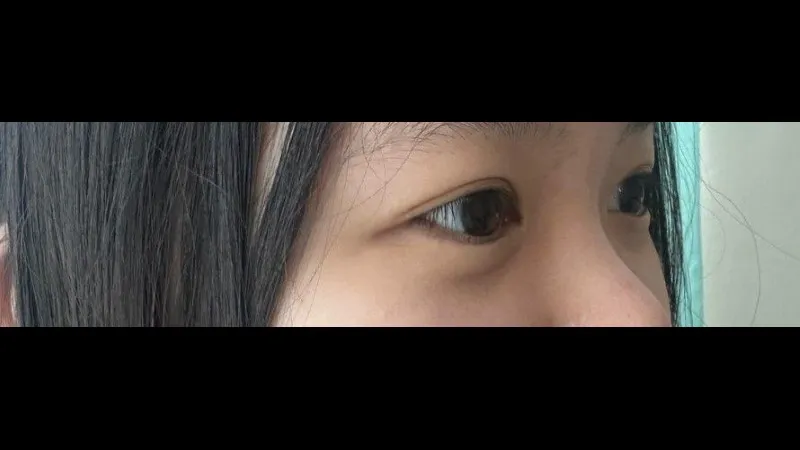 Partial Incision Double Eyelid Surgery, Ptosis Correction — RE&RE PLASTIC SURGERY 2