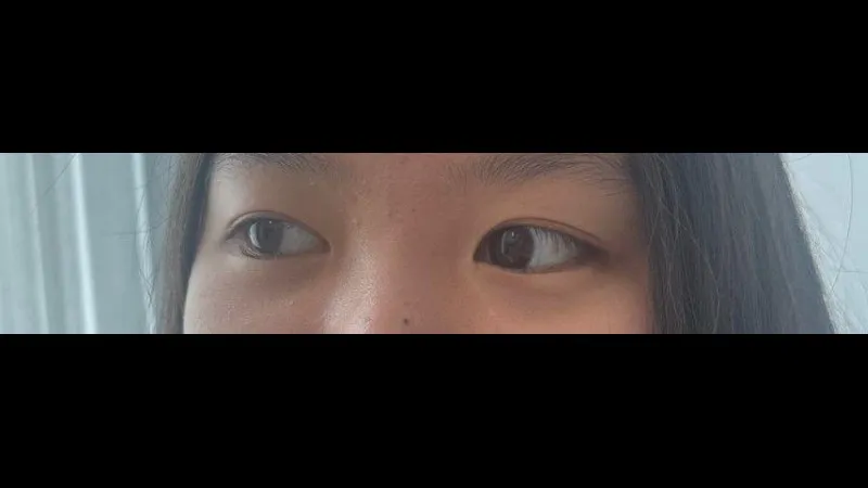 Partial Incision Double Eyelid Surgery, Ptosis Correction — RE&RE PLASTIC SURGERY 3