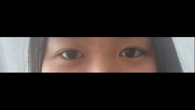 Partial Incision Double Eyelid Surgery, Ptosis Correction — RE&RE PLASTIC SURGERY 4