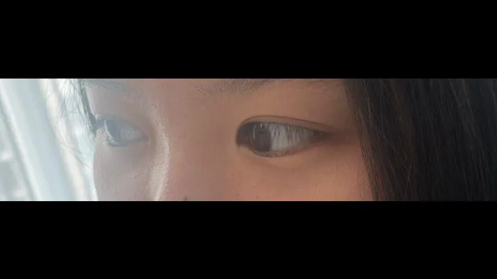 Partial Incision Double Eyelid Surgery, Ptosis Correction — RE&RE PLASTIC SURGERY 5