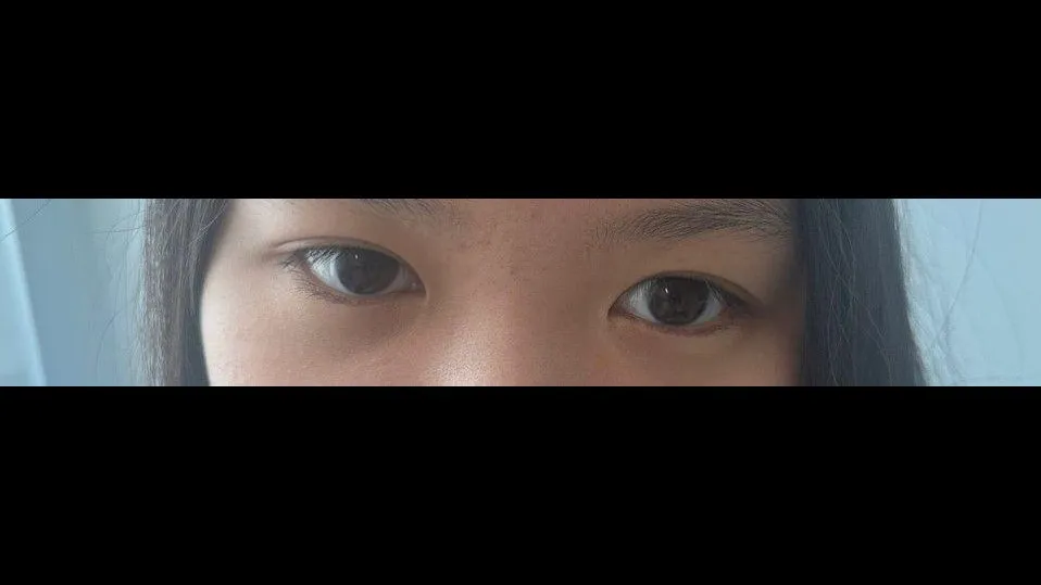 Partial Incision Double Eyelid Surgery, Ptosis Correction — RE&RE PLASTIC SURGERY 6