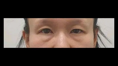 Ptosis Correction, Sub-brow Lift, Lower Blepharoplasty (Aging Eye Rejuvenation) — RE&RE PLASTIC SURGERY 1