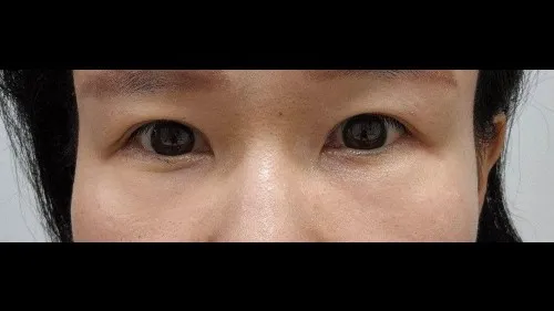 Ptosis Correction, Sub-brow Lift, Lower Blepharoplasty (Aging Eye Rejuvenation) — RE&RE PLASTIC SURGERY 3