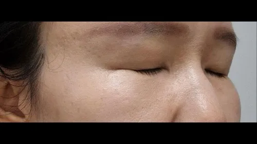 Ptosis Correction, Sub-brow Lift, Lower Blepharoplasty (Aging Eye Rejuvenation) — RE&RE PLASTIC SURGERY 4