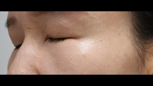 Ptosis Correction, Sub-brow Lift, Lower Blepharoplasty (Aging Eye Rejuvenation) — RE&RE PLASTIC SURGERY 5