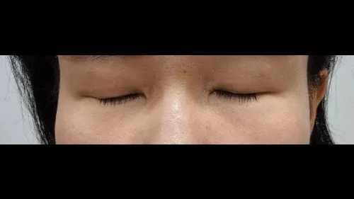 Ptosis Correction, Sub-brow Lift, Lower Blepharoplasty (Aging Eye Rejuvenation) — RE&RE PLASTIC SURGERY 6