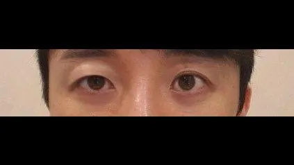 Partial Incision Double Eyelid Surgery, Incisional Double Eyelid Surgery — RE&RE PLASTIC SURGERY 2