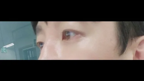 Partial Incision Double Eyelid Surgery, Incisional Double Eyelid Surgery — RE&RE PLASTIC SURGERY 3
