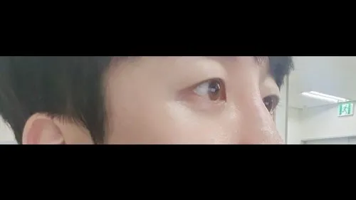 Partial Incision Double Eyelid Surgery, Incisional Double Eyelid Surgery — RE&RE PLASTIC SURGERY 4