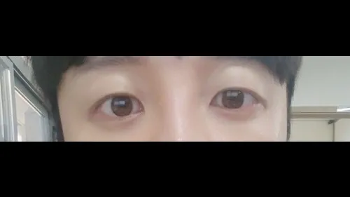Partial Incision Double Eyelid Surgery, Incisional Double Eyelid Surgery — RE&RE PLASTIC SURGERY 5