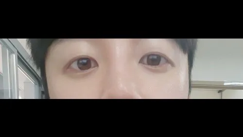 Partial Incision Double Eyelid Surgery, Incisional Double Eyelid Surgery — RE&RE PLASTIC SURGERY 6